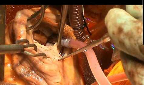 Anterior leaflet destroyed by vegetation and posterior leaflet prolapse.