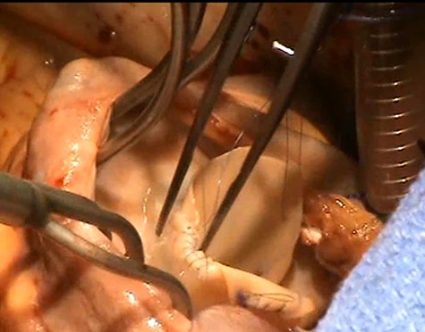 Reconstruction of the anterior leaflet with the Admedus decellularized bovine pericardial patch.