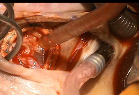Demonstration of a competent tricuspid valve following complex tricuspid valve reconstruction