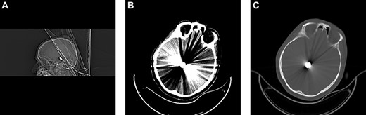 Brain CT upon admission revealed the bullet fragment located deep to the convexity of the skull. (A) Sagittal bone window. (B) Brain. (C) Axial bone window.