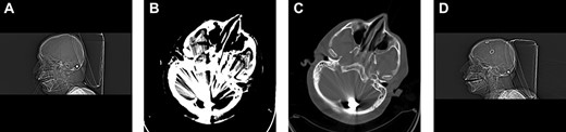 Follow-up CT after 10 days of admission revealed inferior and retrograde migration of the bullet to the left cerebellar peduncle. (A) Sagittal bone window. (B) Brain. (C) Axial bone window. (D) Postshunt operation control. Sagittal bone window. Ventricular catheter is observed.