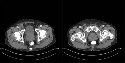 Axial CT abdomen with oral contrast showing a dilated appendix periappendiceal fat stranding within a right inguinal hernia and no evidence of rupture.