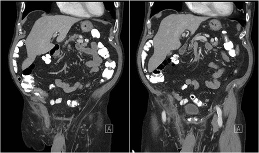 Coronal CT abdomen with oral contrast showing a dilated appendix periappendiceal fat stranding within a right inguinal hernia and no evidence of rupture.