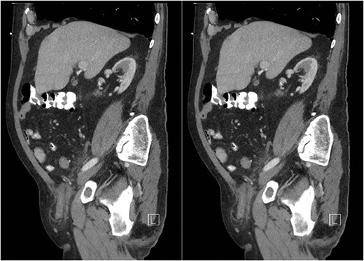 Sagittal CT abdomen with oral contrast showing a dilated appendix periappendiceal fat stranding within a right inguinal hernia and no evidence of rupture.