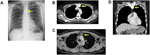 (A) Chest X-ray showing a calcification tumor in anterior mediastinum (arrow). (B) A chest computed tomography scan of horizontal section showing a 40-mm calcification tumor in anterior mediastinum. (C) A chest computed tomography scan of coronal section showing a 40-mm calcification tumor in anterior mediastinum. (D) MRI scan showing T1-weighted heterogeneous signal intensities.