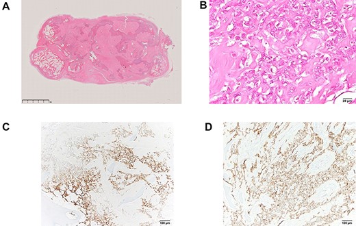 (A, B) Pathological finding revealed that mediastinal tumor was type B3 thymoma with massive calcification. (C, D) Immunological staining of the tumor showed positivity for AE1/3 (C) and CAM 5.2 (D). CD3-positive T-cells and CD5-positive T-cells were infiltrated around the tumor, whereas the tumor was negative for CD3 and CD5.