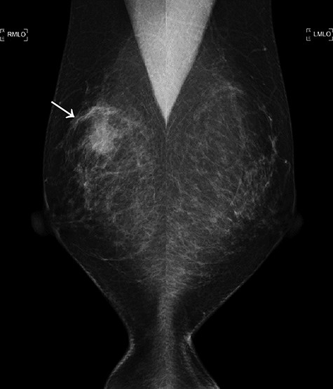 The first mammogram. The mammogram displaying a highly dense micro-serrated mass in the right upper lateral region (arrowhead).