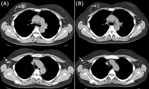 CT images of right breast tumor before and after treatment. (A) Chest CT displaying nodules in the right breast (top, arrowhead) and lymph node swelling in the right axilla (bottom, arrowhead); (B) after administration of NAC, the primary tumor (top, arrowhead) and axillary lymph nodes (bottom, arrowhead) displayed a clear reduction in size.