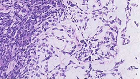 Histopathological features of right breast tumor. The biopsy specimen showed high-grade carcinoma cells arranged in solid sheet or thin trabecular structures directly producing matrix, suspected to be matrix-producing carcinoma (metaplastic carcinoma) (hematoxylin and eosin stain, ×400).