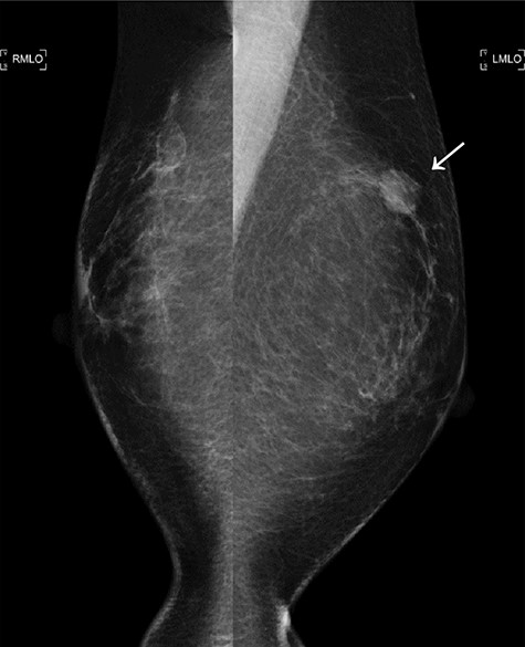 The second mammogram. The mammogram displaying a well-defined borderline high-density mass in the left upper lateral region (arrowhead).