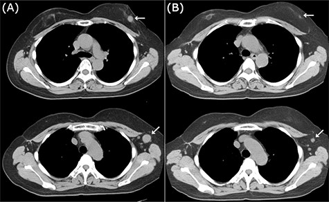 CT images of left breast tumor before and after treatment. (A) Chest CT displaying a nodule in the left breast (top, arrowhead) and lymph node swelling in the left axilla (bottom, arrowhead); (B) Tumors in both the left breast (top, arrowhead, arrowhead) and the axillary lymph node (bottom, arrowhead, arrowhead) shrank after carboplatin and paclitaxel administration.