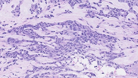 Histopathological features of left breast tumor. The biopsy specimen demonstrated invasive carcinoma with features of metaplastic carcinoma, i.e. without ductal structure, with tumor cell matrix-producing or some spindle cell characteristics (hematoxylin and eosin stain, ×400).
