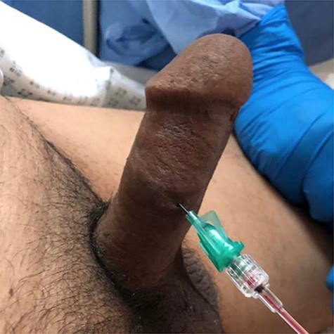 Patients penis prior to starting aspiration and awaiting penile blood gasses.
