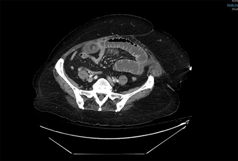 A CT abdomen and pelvis scan showing a large stone in the small bowel.