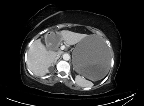 A CT abdomen and pelvis scan showing a wide neck fistula.