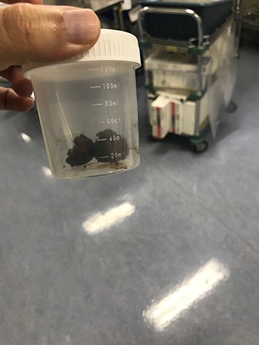 The extracted stone from the small bowel. Note that it was extracted as one piece.