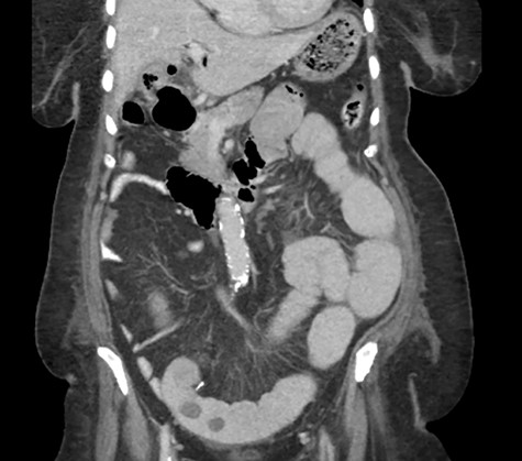 A CT abdomen and pelvis scan showing multiple large stones in the small bowel.