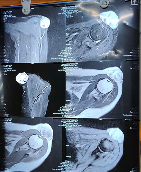 MRI of the shoulder.