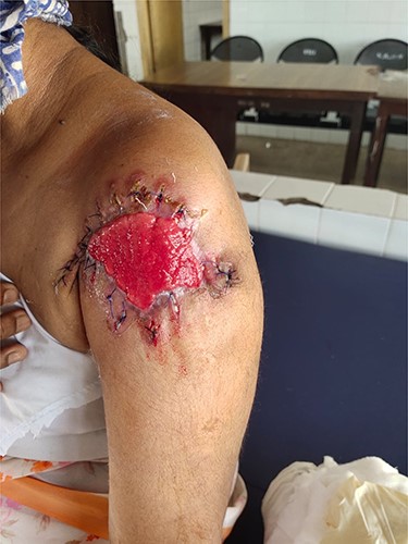 Post wide local excision.