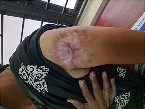Postoperative scar.