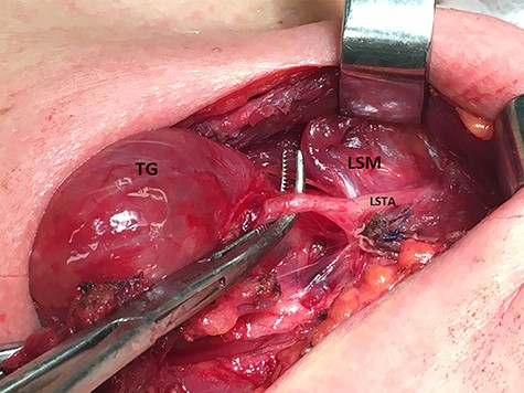 Meticulous exposure of the operative field. TG: thyroid gland, SM: sternothyroid muscle and LSTA: left superior thyroid artery.