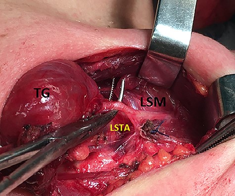 Meticulous exposure of the operative field. TG: thyroid gland, SM: sternothyroid muscle and LSTA: left superior thyroid artery.