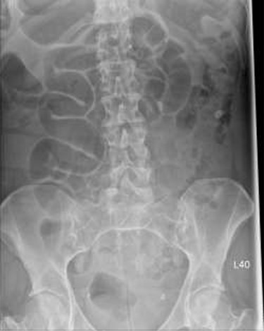 Abdominal X-ray shows twisted dilated small bowel loops.