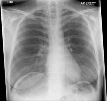 Chest X-ray shows air under diaphragm due to Chilaiditi syndrome.
