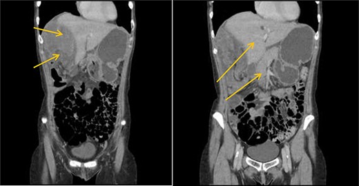 CT scan shows interposition of ileum, cecum and ascending colon between liver and diaphragm pushing right loop of the liver and gallbladder medially.