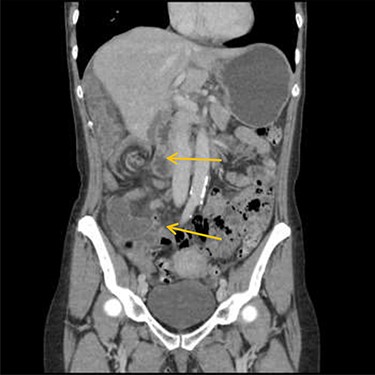 CT scan shows a vascular/mesenteric pedicle swirl suggestive of malrotation or volvulus with evidence of dilated closed loop obstruction.