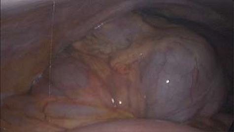 Showing 180 degree volvulus of terminal ileum, cecum and ascending colon overlapped each other and overriding the right loop of the liver.
