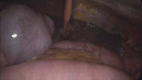 Showing floppy dilated cecum ileum and ascending colon twisted around the liver and mesentery.