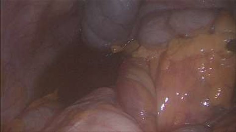 Turbid free fluid in the right para-colic gutter.