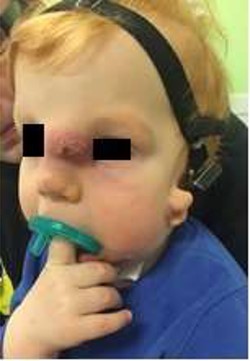 Presurgical appearance of an infected nasal dermoid cyst.