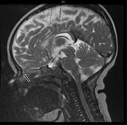 T2-weighted sagittal MRI of hyperintense soft tissue findings in the setting of a nasal dermoid cyst penetrating the anterior cranial fossa.