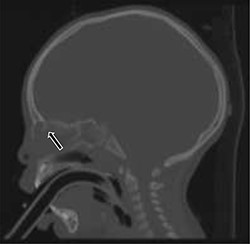 Sagittal cranial CT scan with bone window showing splaying of the nasal bone; a severe osseous defect potentiating extension into the intracranial space.