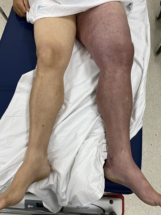 Patient presents with a grossly swollen and discoloured left leg.