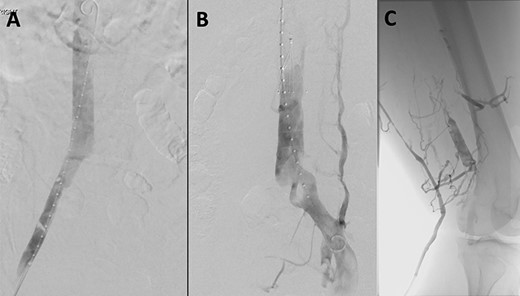 (A) Venogram illustrating patent IVC and renal vein position. (B) Post-thrombectomy venogram showing fenestrated left common iliac vein. (C) Venogram illustrating patent popliteal vein via small saphenous vein access.