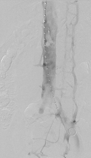 Venogram of the IVC illustrating acute thrombus in the filter.