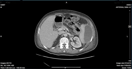 CT showing descending colon wall thickening in contact with the spleen and the tail of the pancreas and a subcapsular splenic abscess as well as splenic vein thrombosis.