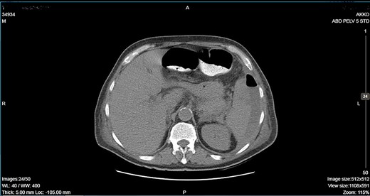 CT showing an important decrease of the abscess due to its rupture toward the peritoneal cavity and presence of air in the abdominal cavity.