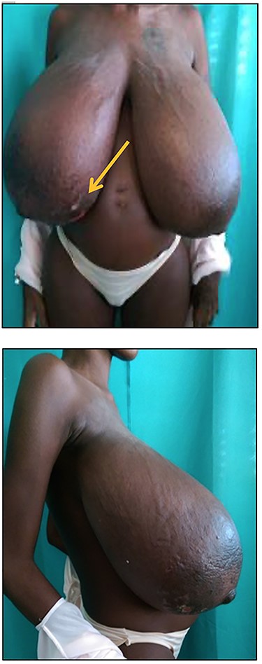 Photograph showing progressive enlargement of bilateral gigantomastia. Note the distended superficial veins and local ulceration to the lower inner quadrant of the right breast (arrow).
