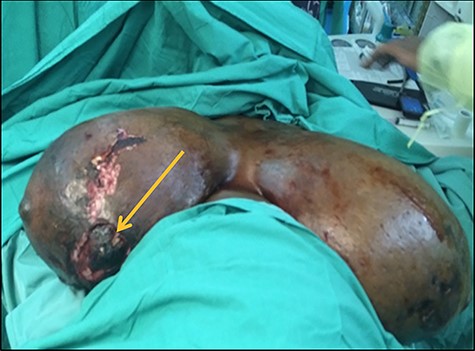 Intraoperative findings showing significant ulceration to lower inner aspect of right breast. Note the clot to the larger ulcerated area (arrow).