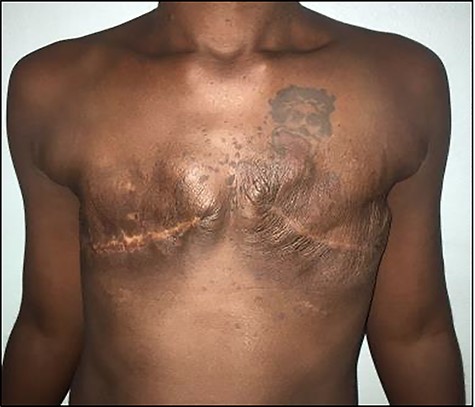 Photograph showing patient 2 months post-operation following bilateral simple mastectomy.