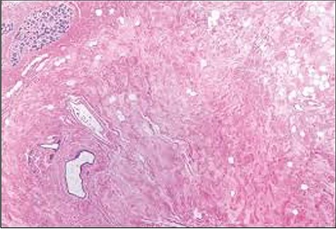 Histological slide showing moderately oedematous interlobular stroma surrounding a normal lobule with lymphangiectasia.