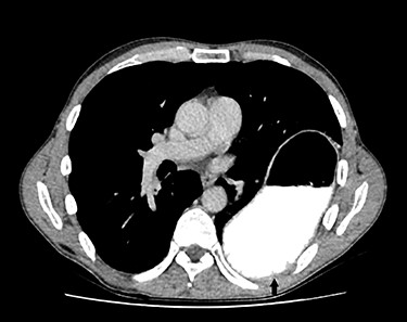 Dependent viscera sign.