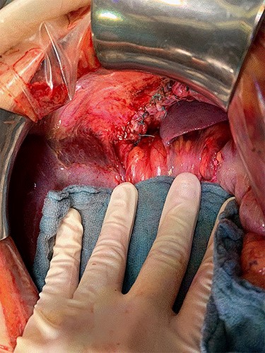 Direct suture.