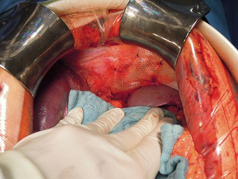 Mesh augmentation.