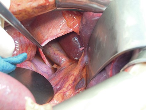 Right-sided diaphragmatic hernia.