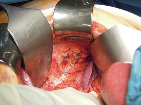 Intact left-sided suture 1.